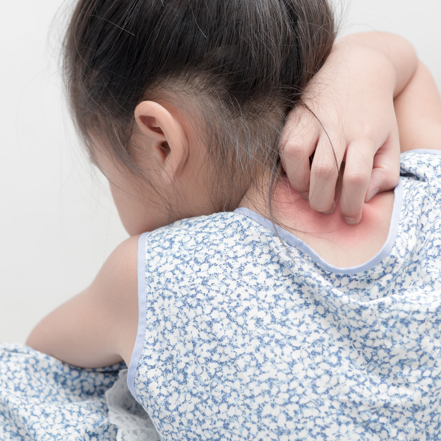 New Study: Eczema Reduces Children’s Sleep Quality